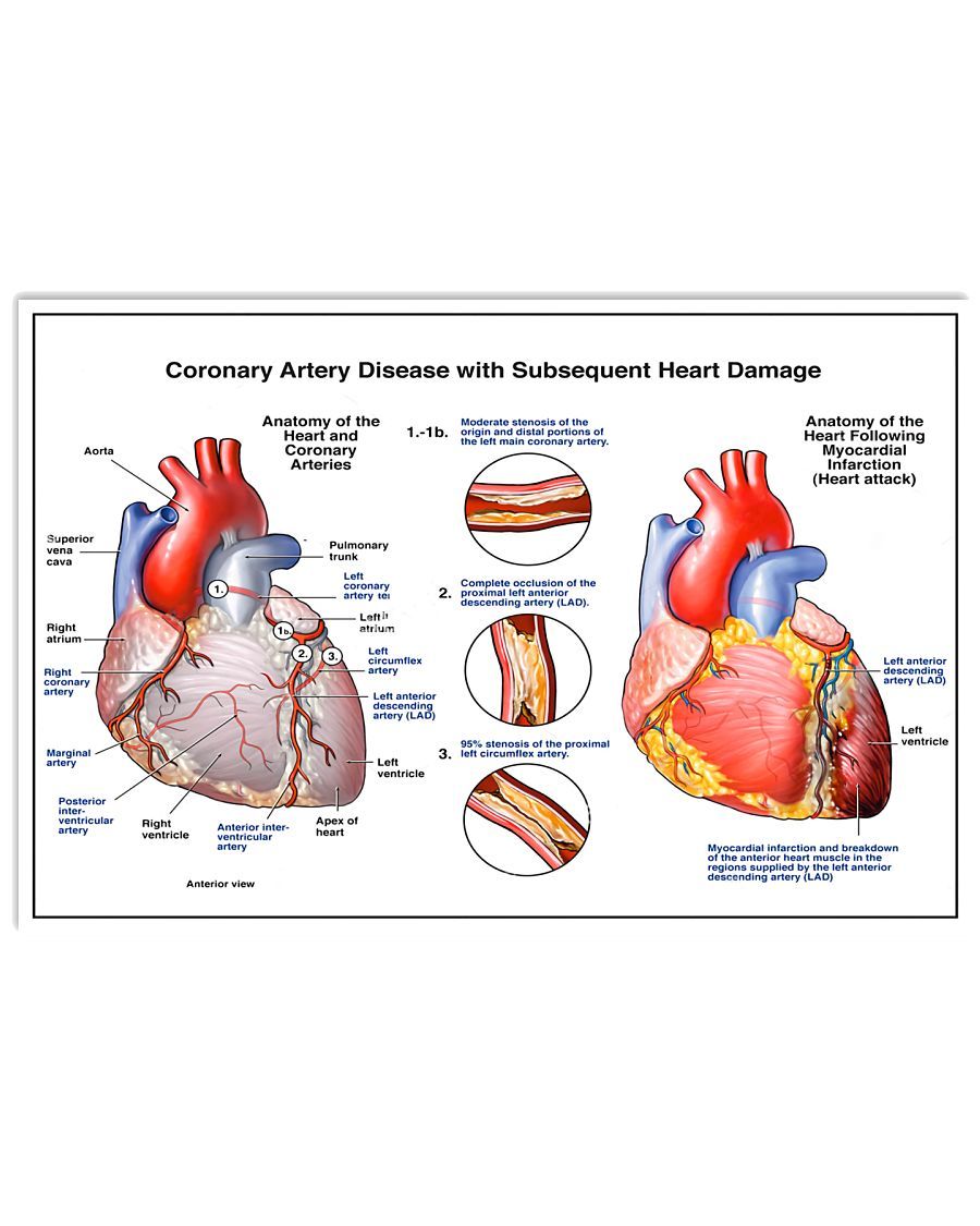Coronary Artery Disease | Teetiv.com