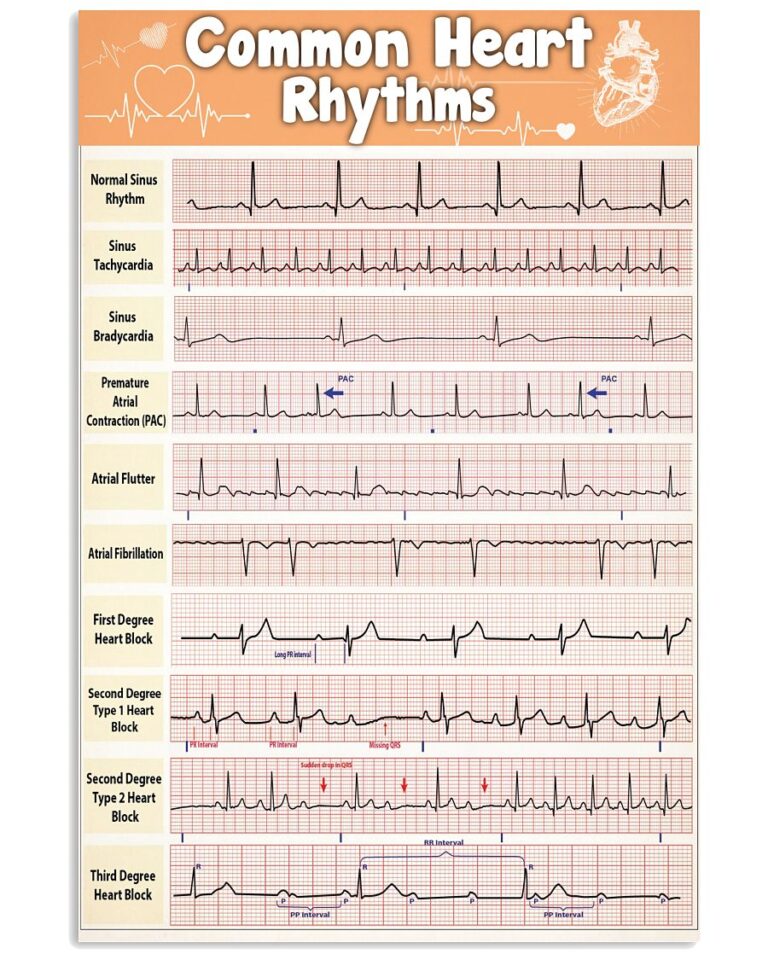 Cardiologist Common Heart Rhythms | Teetiv.com