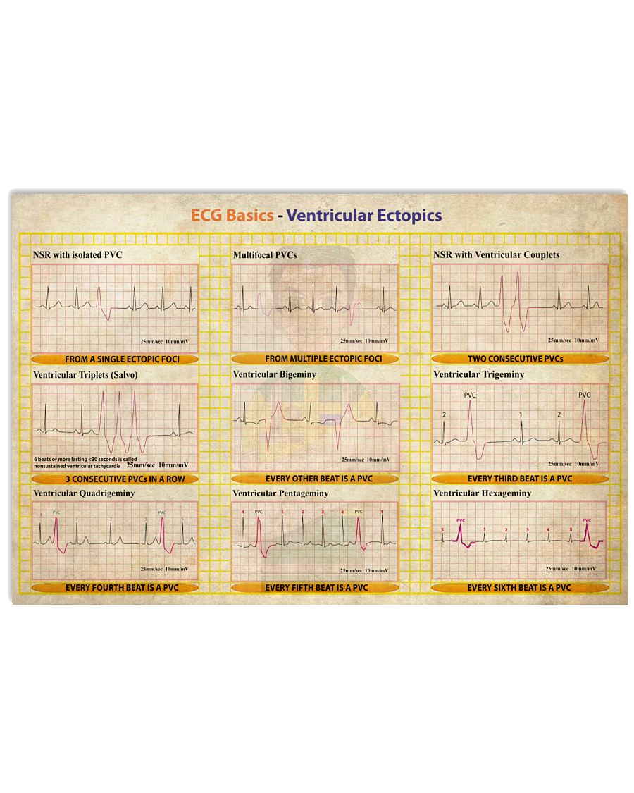 Cardiologist Ecg Basic Ventricular Ectopics